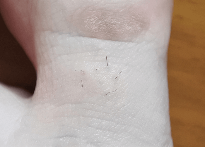 トリアパーソナルレーザー脱毛器4Ｘによる足指脱毛2回目（1ヶ月後）